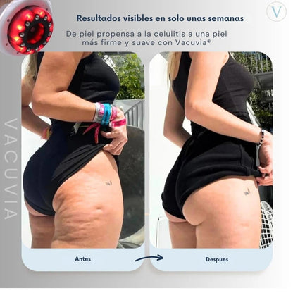 Masajeador Succionador Vacuvia® para la celulitis - TodoBacano